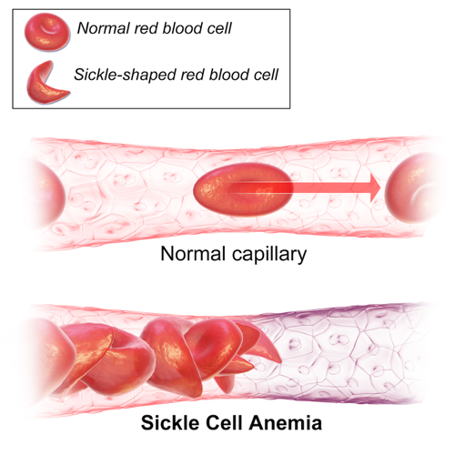 Sickle shaped blood cells