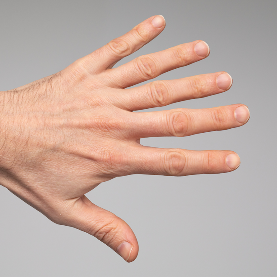 How can polydactyly happen when it’s not inherited? - The Tech Interactive