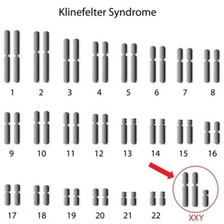 Chromosomes of someone with Klinefelter syndrome.