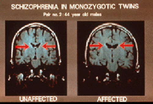 MRI images of schizophrenia in identical twins.