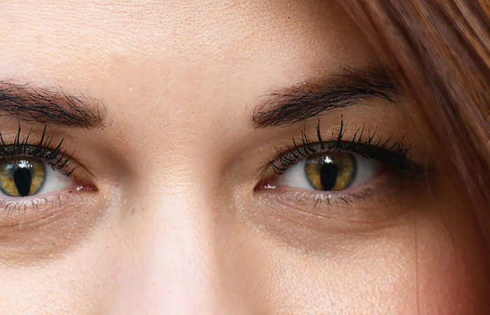 Coloboma girls eyes.