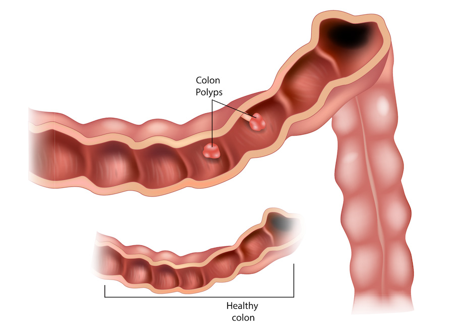 A medical illustration of a healthy colon compared to a colon with polyps.