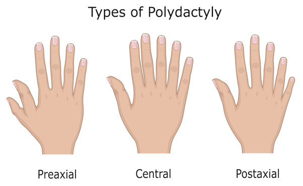 Illustration of the three main types of polydactyly.