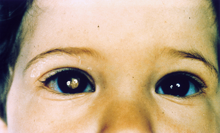 Retinoblastoma.