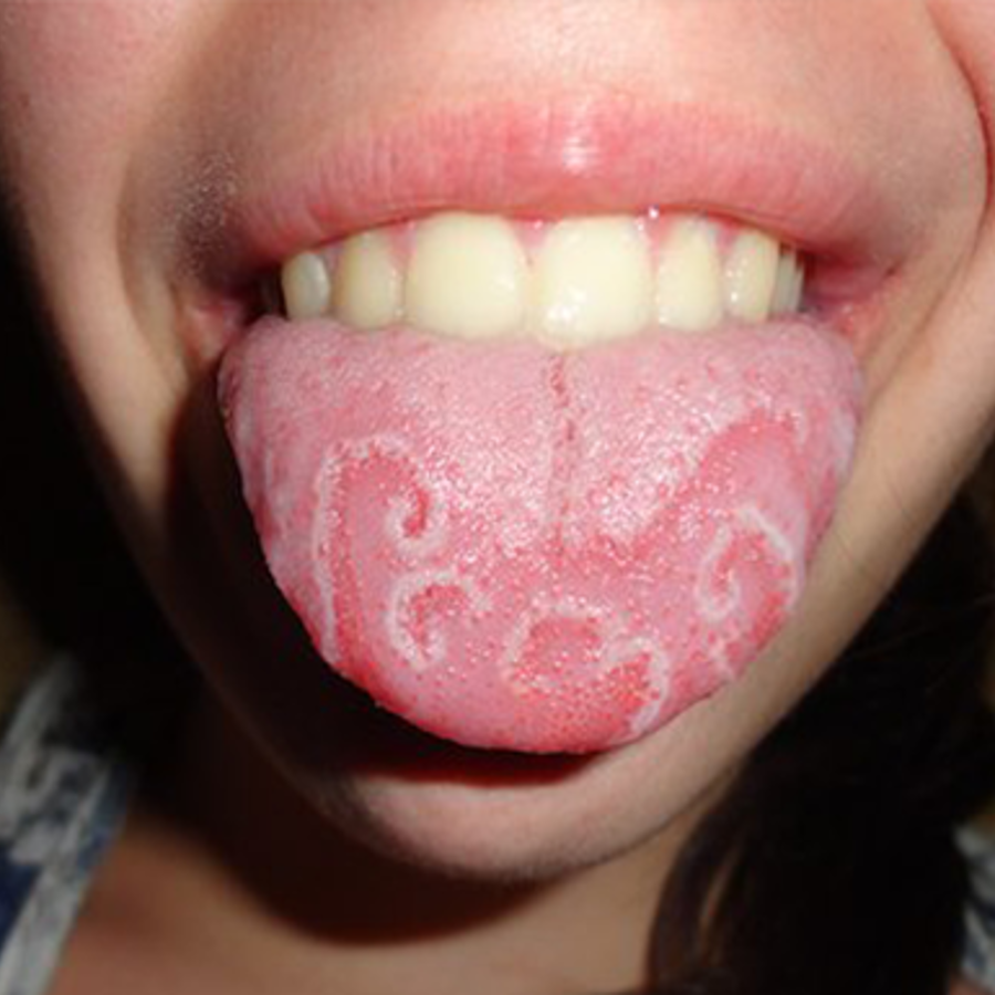 What is geographic tongue and is it The Tech Interactive