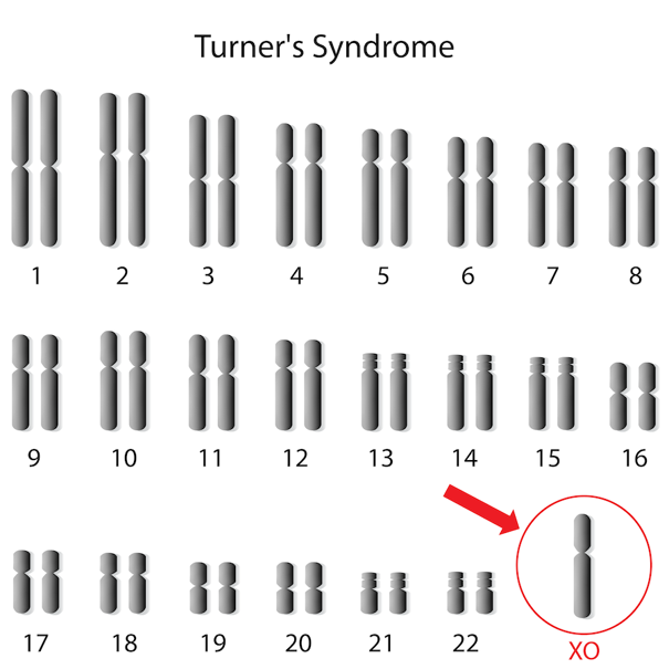 A karyotype of a person with only one X chromosome.