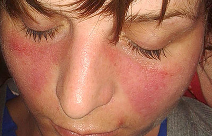 Lupus rash.
