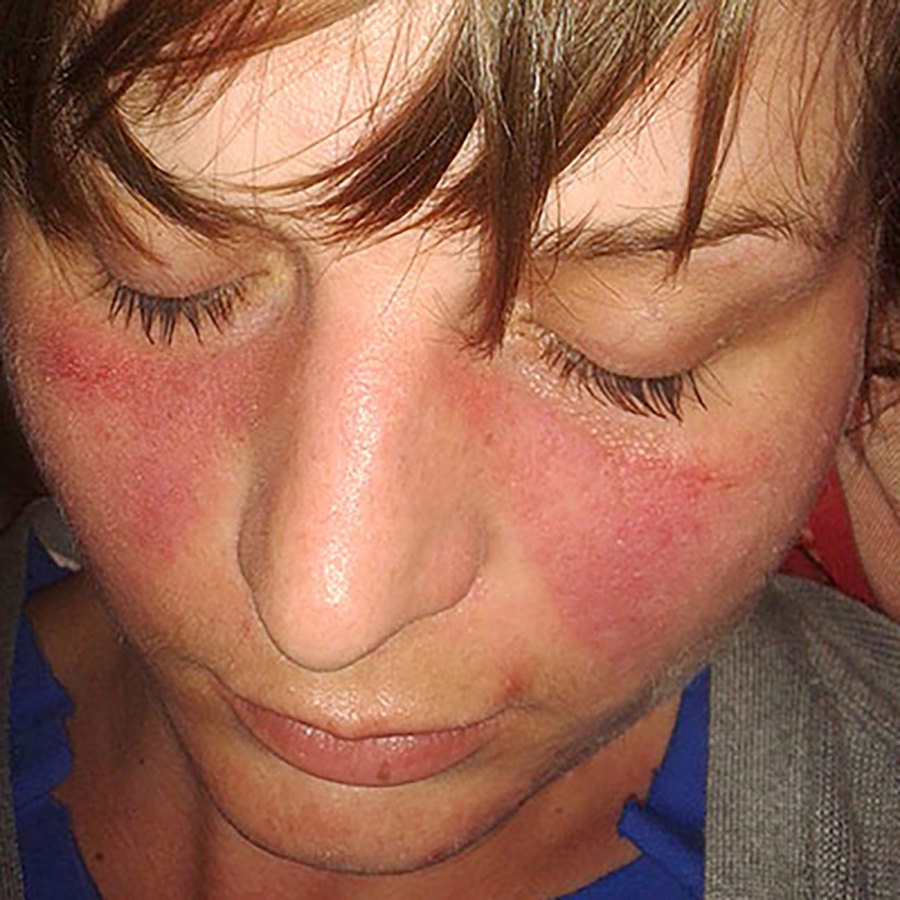 Lupus rash.