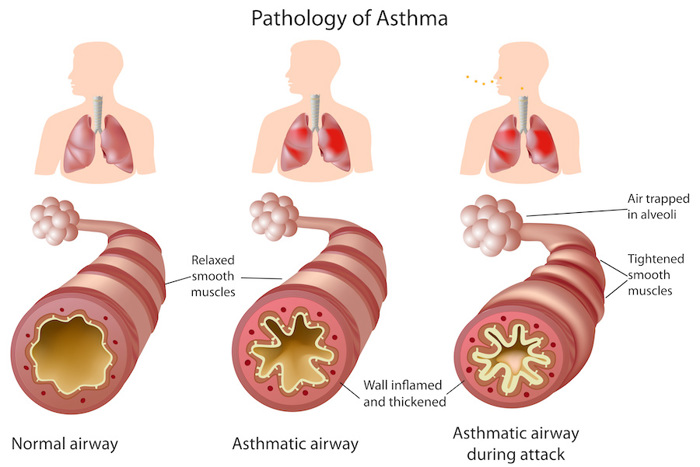 Asthmatic airways are more inflamed than typical airways.