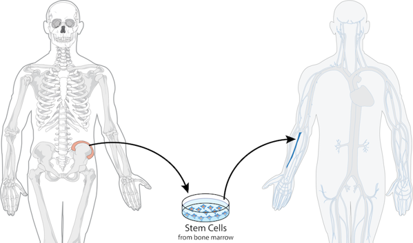 Bone marrow transplant