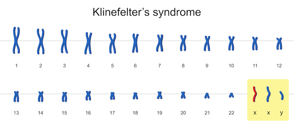 Klinefelter karyotype