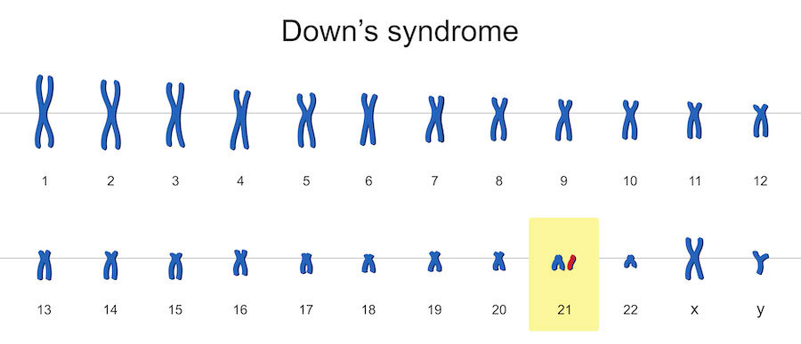 Down syndrome karyotype.