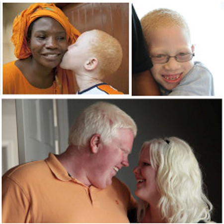 People with albinism.