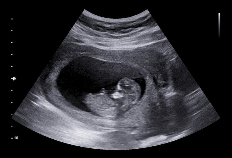 Ultrasound at 12 weeks.
