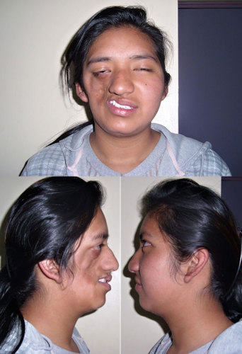 Parry Romberg Syndrome.