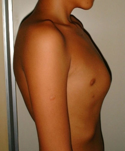 Child with Pectus Carinatum