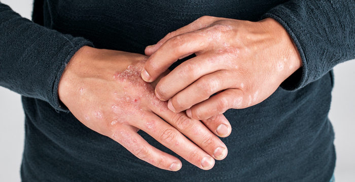 Hands with eczema.