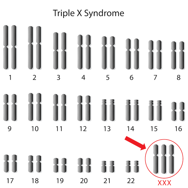 A karyotype of a person with only one X chromosome.