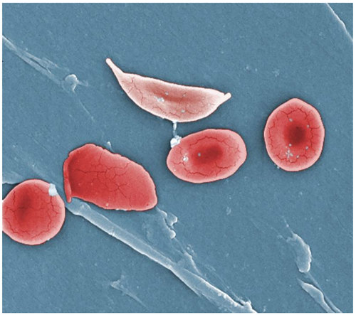 Sickle shaped blood cells.