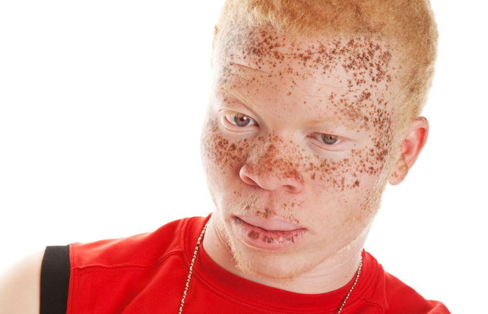 Man with rufous albinism.