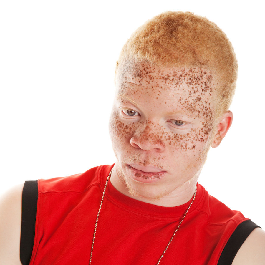 Man with rufous albinism.