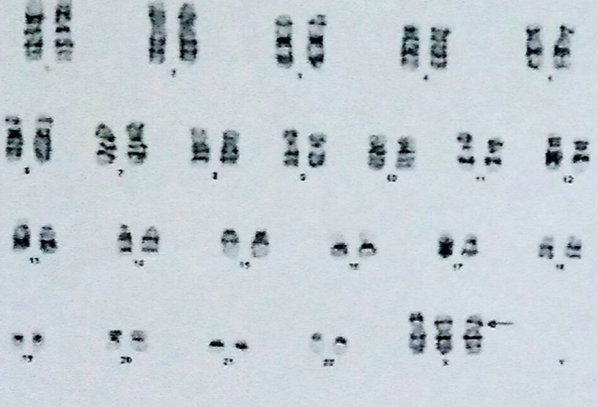XXX karyotype