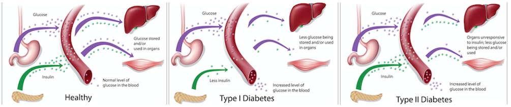 Diabetes types 1 and 2.