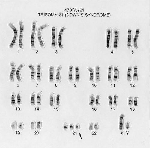 Down syndrome karyotype.