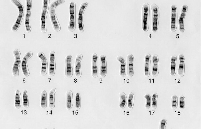 Down syndrome karyotype.