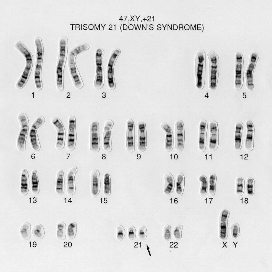 Down syndrome karyotype.