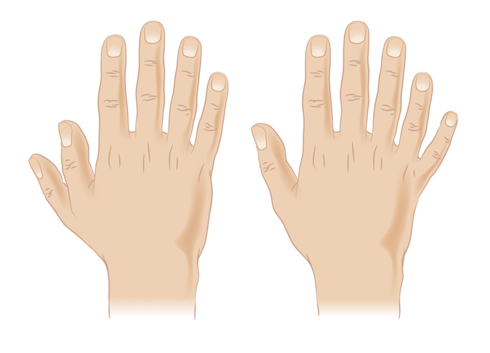 Polydactyly.