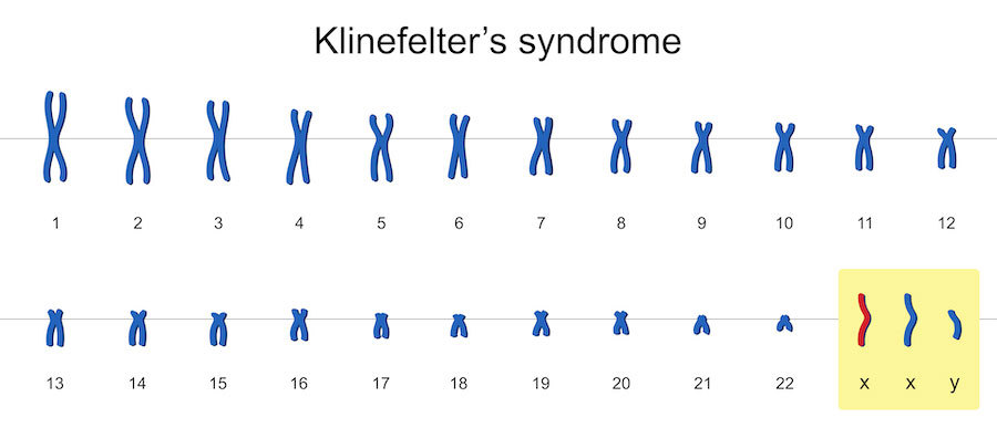 Klinefelter karyotype.