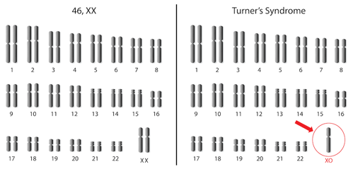 Typical karyotype vs. Turner's syndrome