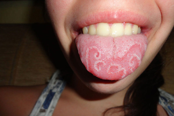 Geographic tongue.