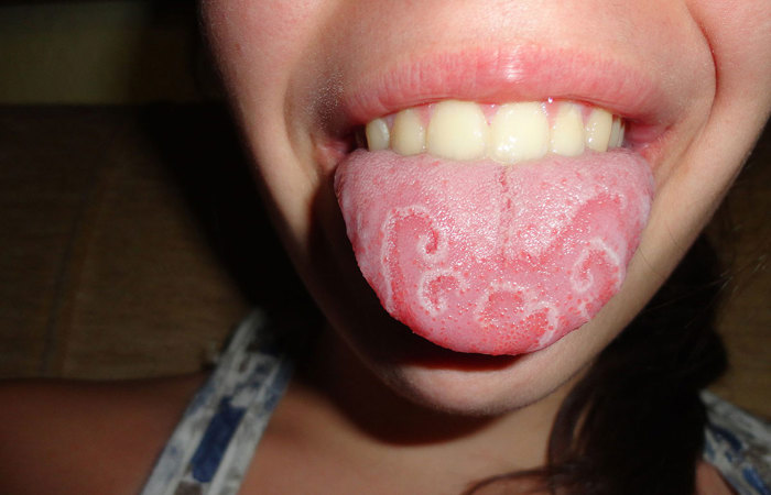 Geographic tongue.