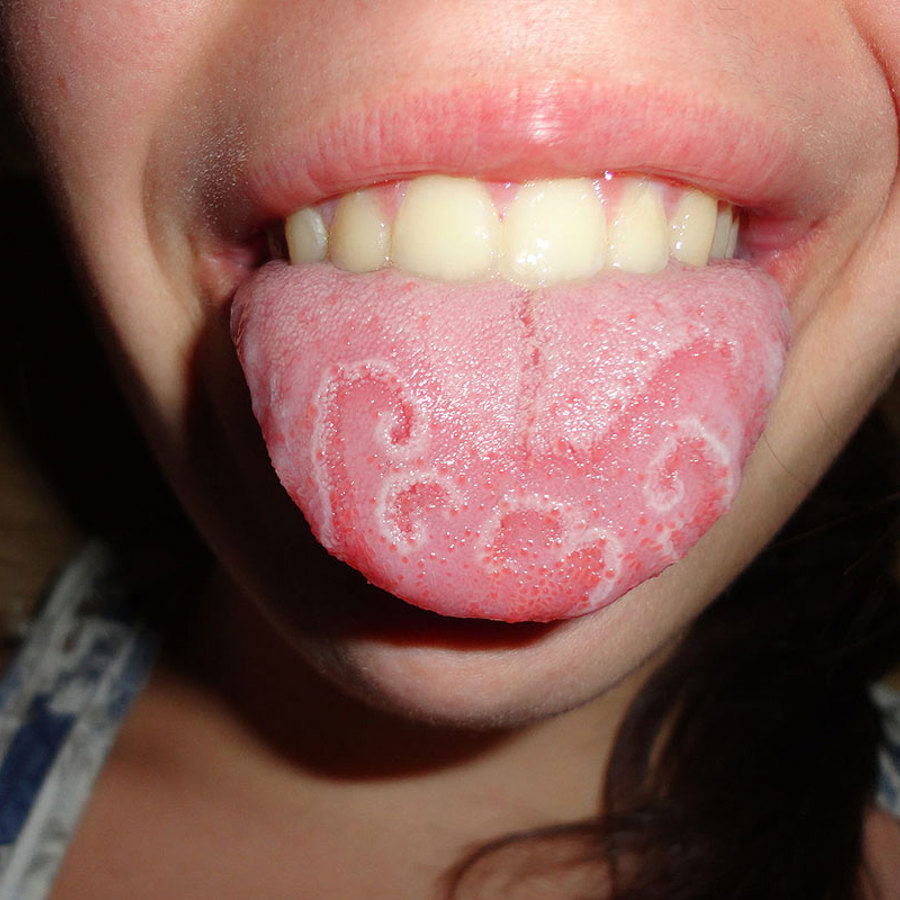 Geographic tongue.