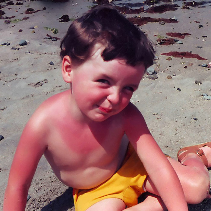 A sunburned child.