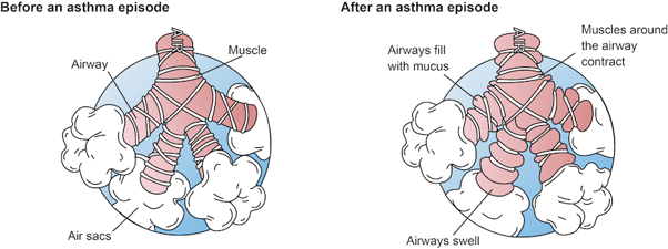 Airways before and after asthma attack