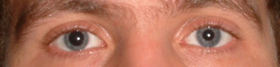 Eyes with different sized pupils.