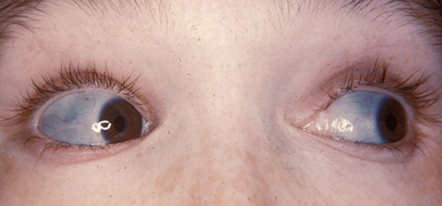 What determines eye color?