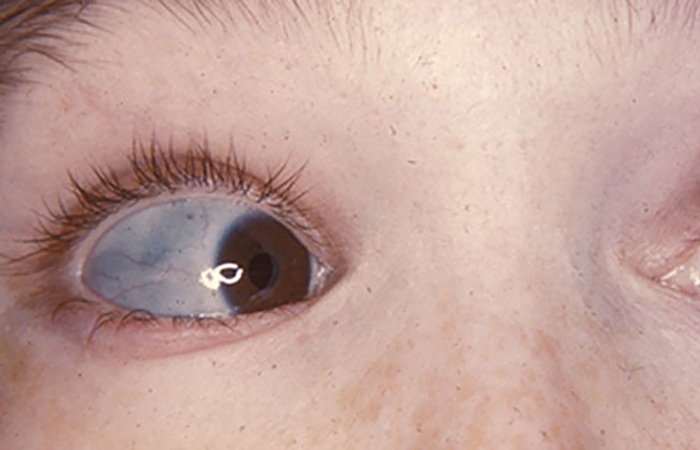 Osteogenesis imperfecta sclerae.