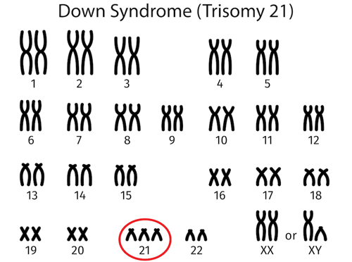 Chromosomes of person with Down syndrome
