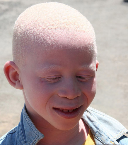 A person with albinism.