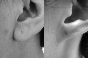 Unattached earlobe (left) and attached earlobe (right).
