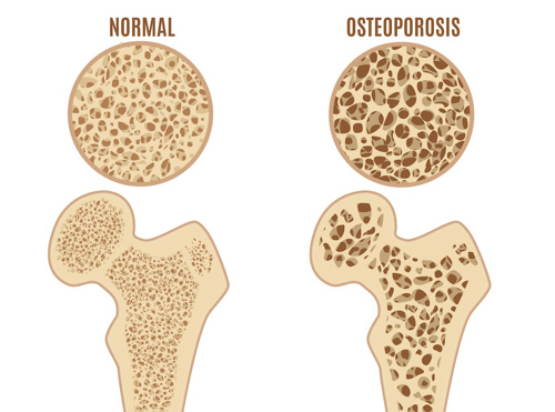 A healthy bone with small holes is shown next to a bone with osteoporosis that has large holes.