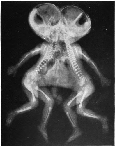X-ray of conjoined twin infants.