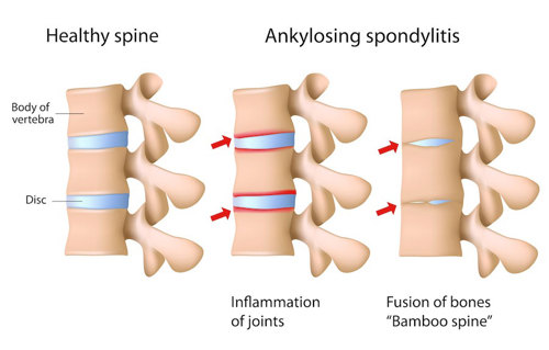 Ankylosing Spondylitis.