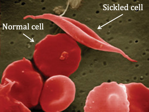 Sickled blood cell