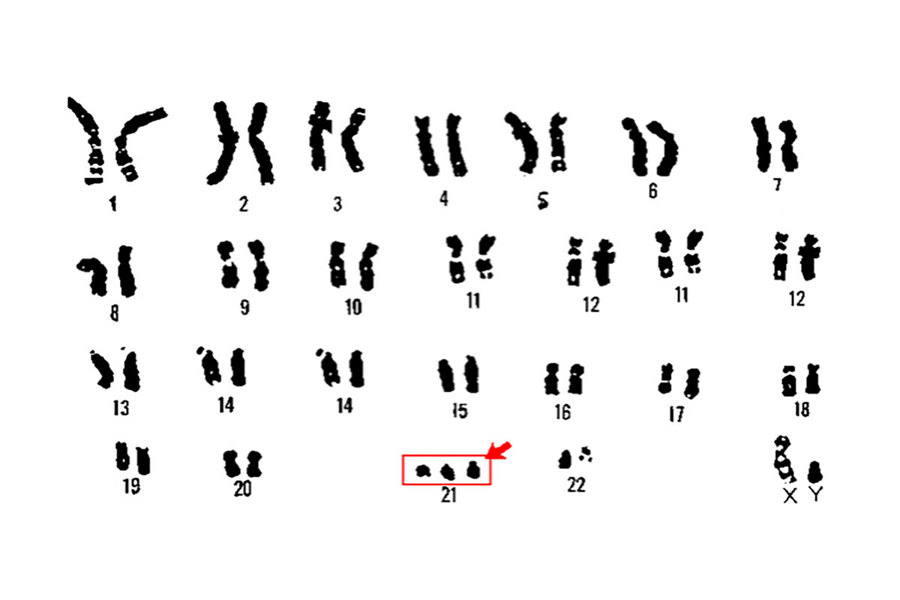 Chromosomes from a person with Down syndrome.