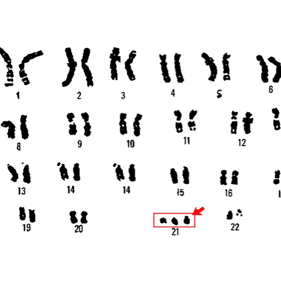 Chromosomes from a person with Down syndrome.